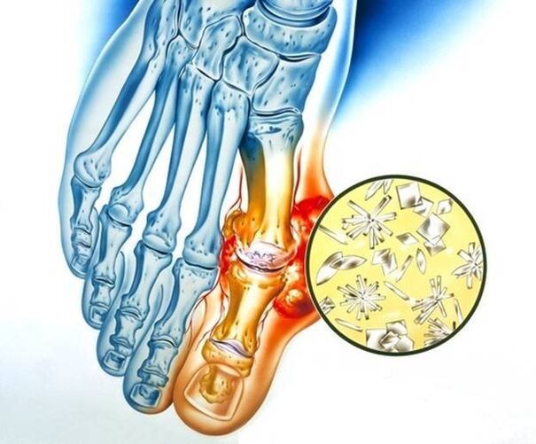 Dépôt d'urate dans la goutte, provoquant une inflammation de l'articulation